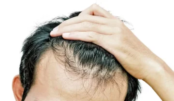 أهم أسباب تساقط الشعر للرجال وطرق الوقاية منها