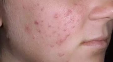 سبب ظهور حبوب صغيره في الوجه