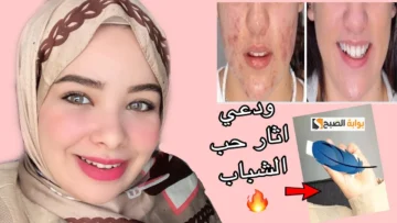 كريم عشبة النيم لإزالة حب الشباب وتفتيح لون البشره هتفاجيء الكل بفوائدها السحرية