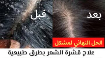 علاج القشرة بطرق طبيعية