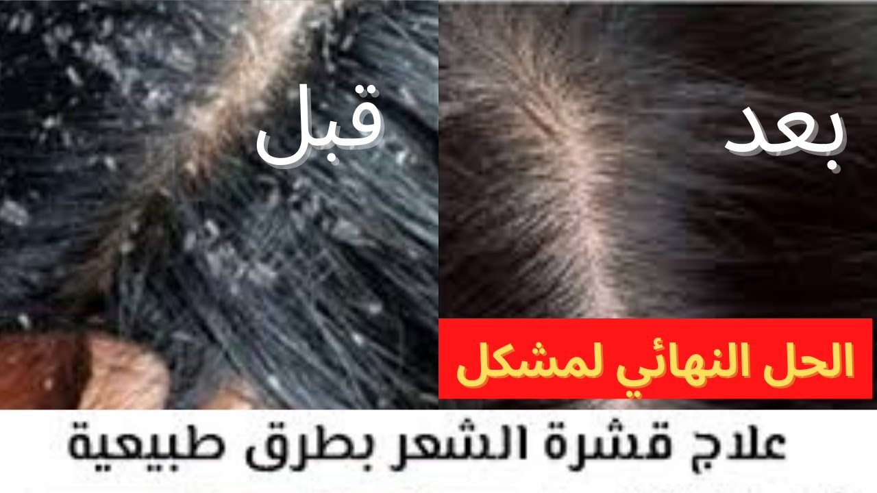 كيف تتخلص من القشرة في الشعر نهائياً بطريقة طبيعية
