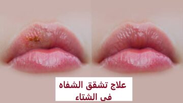 5 وصفات سحرية بمواد طبيعية لنعومة الشفاه وترطيبها من التشقق بالشتاء