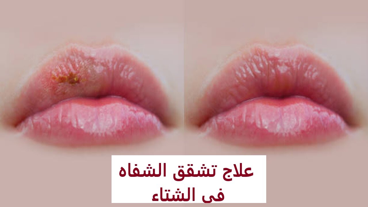 5 وصفات سحرية بمواد طبيعية لنعومة الشفاه وترطيبها من التشقق بالشتاء 5 5 وصفات سحرية بمواد طبيعية لنعومة الشفاه وترطيبها من التشقق بالشتاء