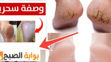علاج تشقق القدمين 1