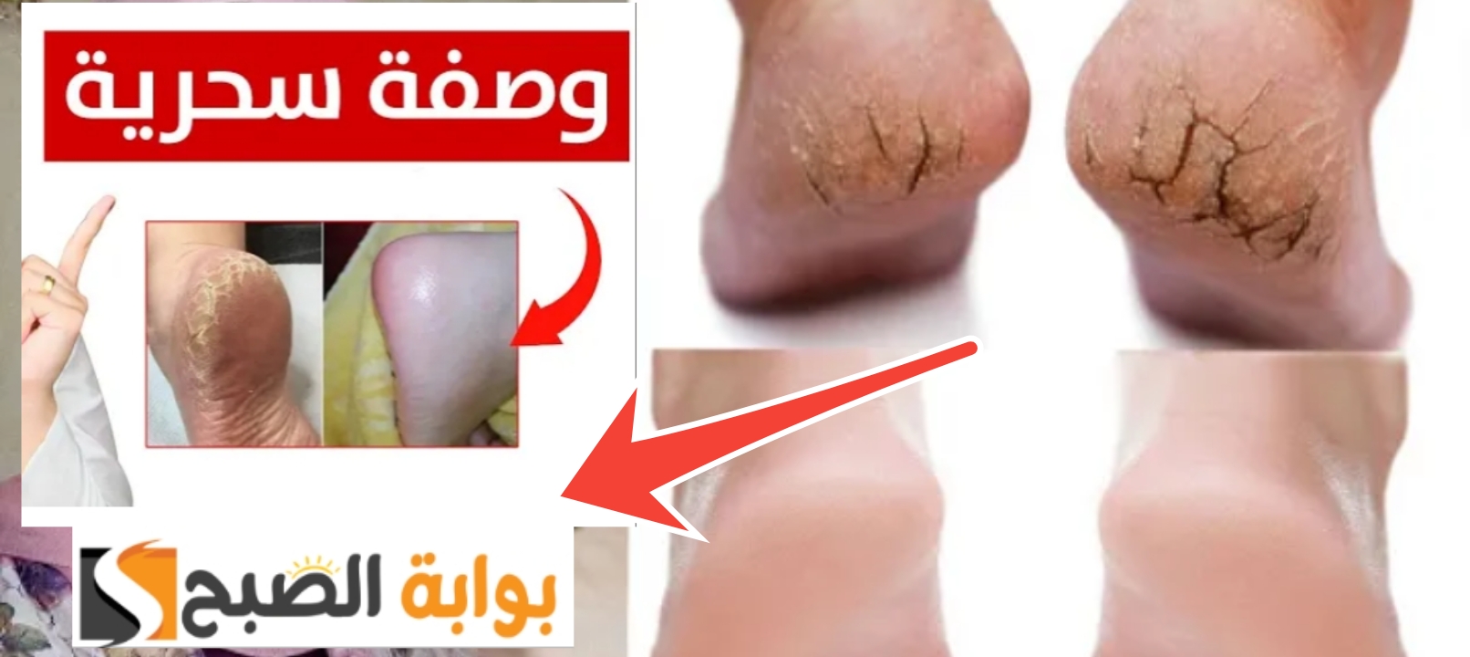 طريقة التخلص من تشقق القدمين نهائيًا طرق طبيعية وفعالة 100 % 5 طريقة التخلص من تشقق القدمين نهائيًا طرق طبيعية وفعالة 100 %
