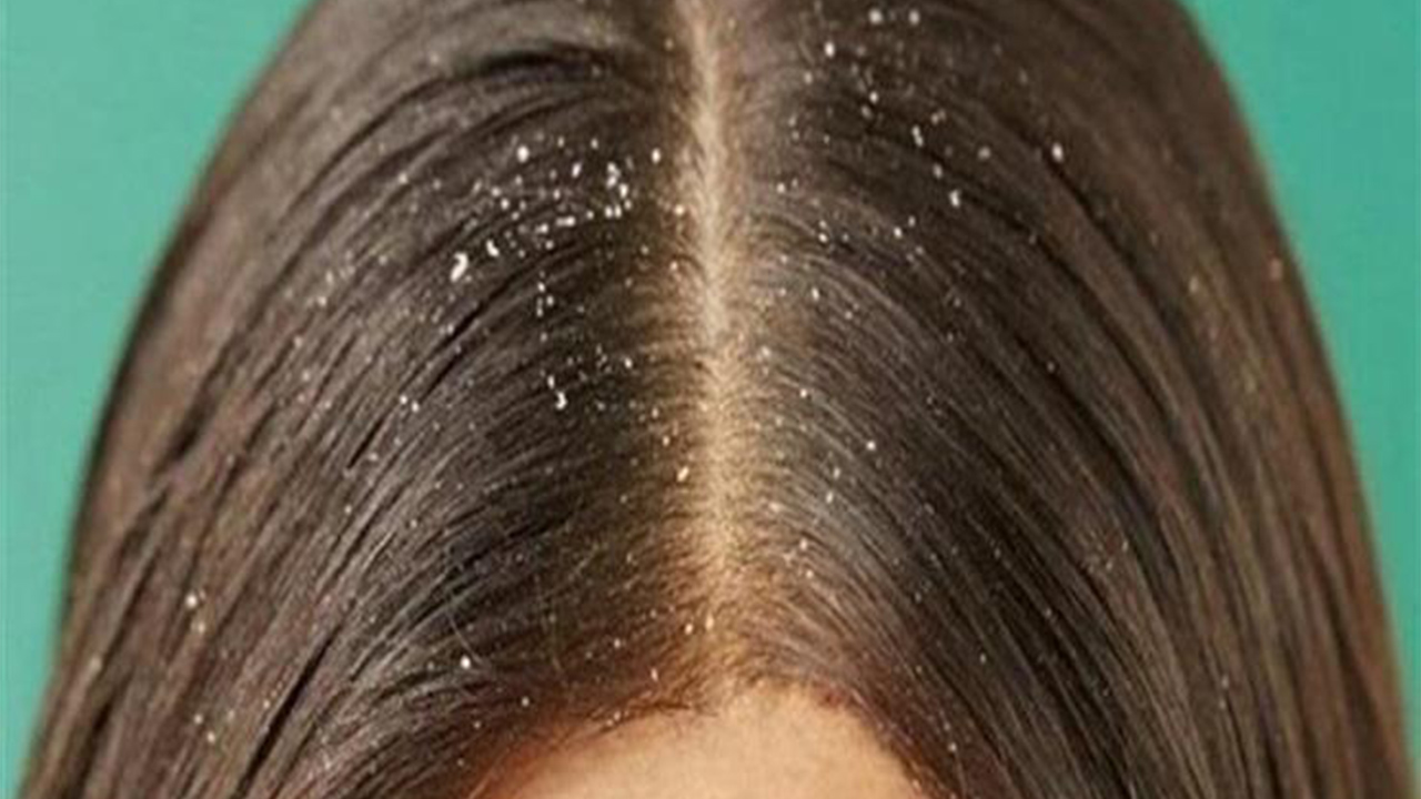 ضع ملعقة خل على شعرك في الصباح لمدة 5 دقائق واندهش لما سيحدث لك 5 ضع ملعقة خل على شعرك في الصباح لمدة 5 دقائق واندهش لما سيحدث لك