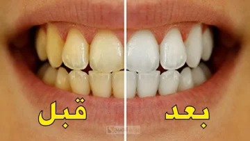 لابتسامة نجوم هوليود.. طرق مضمونة لتبييض الأسنان بمكونات طبيعية وفعالة هتشيل الصفار في دقايق