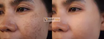 كل مشكلة ولها حل.. وصفات طبيعية للتخلص من ندبات حب الشباب بمكونات على قد الإيد