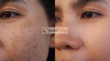 ندبات حب الشباب