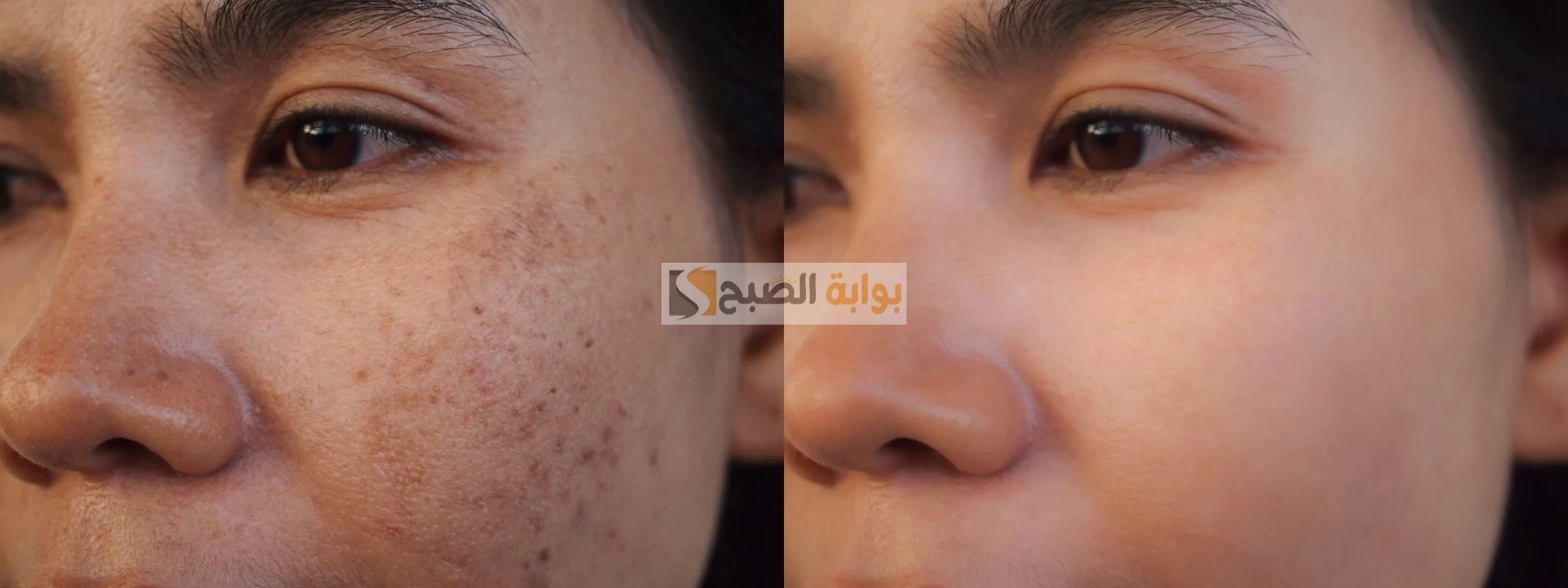 كل مشكلة ولها حل.. وصفات طبيعية للتخلص من ندبات حب الشباب بمكونات على قد الإيد 5 كل مشكلة ولها حل.. وصفات طبيعية للتخلص من ندبات حب الشباب بمكونات على قد الإيد