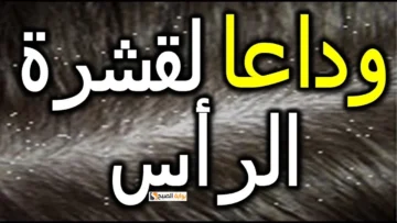 وصفات طبيعيه للتخلص من قشرة الشعر نهائيا بأقل تكلفة ومن مكونات منزلية