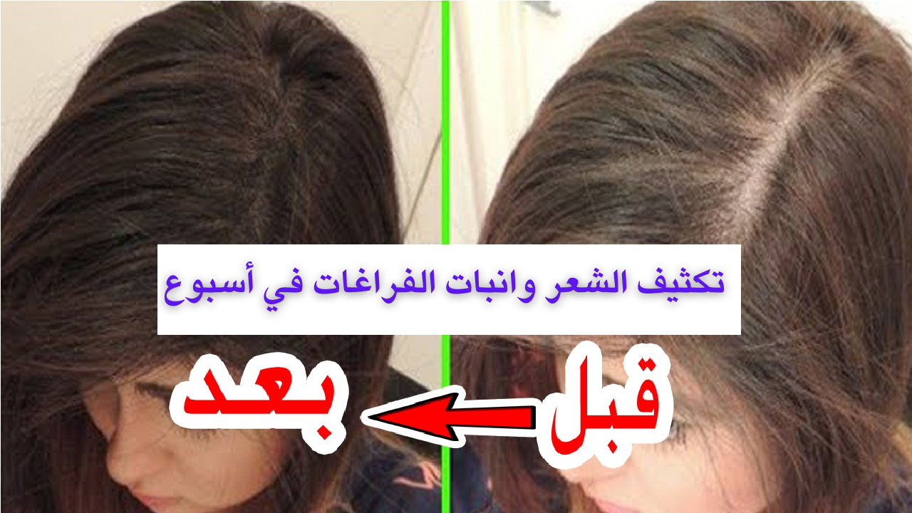 أسرع خلطة طبيعية لتكثيف الشعر الخفيف وإنبات فراغات مقدمة الرأس 5 أسرع خلطة طبيعية لتكثيف الشعر الخفيف وإنبات فراغات مقدمة الرأس