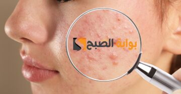 تخلصي من حب الشباب بسرعة وصفة لإزالة الحبوب من الوجه في يوم واحد