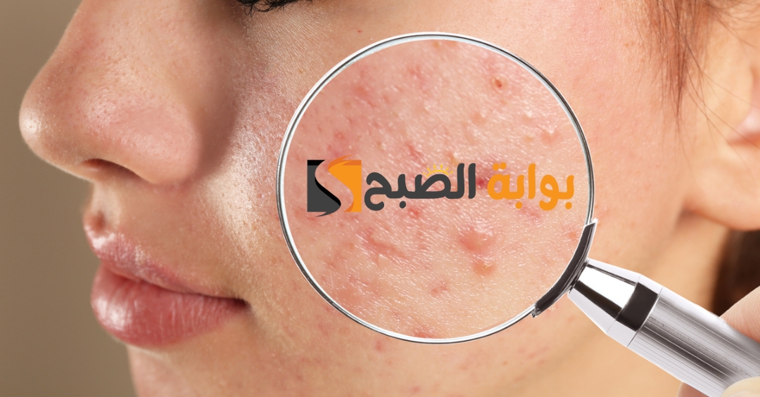 تخلصي من حب الشباب بسرعة وصفة لإزالة الحبوب من الوجه في يوم واحد