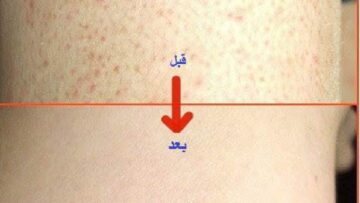 إزالة جلد الوزة من البشرة بطرق طبيعية هتمنحك نعومة ولمعان