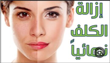 اقوى الوصفات الطبيعية المجربة للتخلص من الكلف والنمش تدريجياً