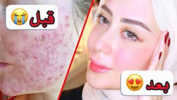 رجعي وشك ينور.. طريقة رائعة للتخلص من آثار حب الشباب واستعادة جمال بشرتك