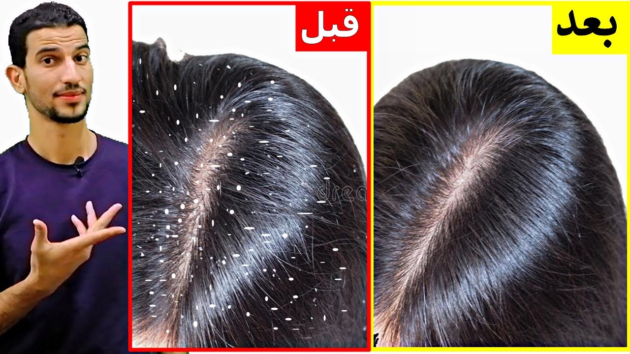 بمكونات موجودة في بيتك.. اقوى وصفة للتخلص من قشرة الشعر نهائيا بدون رجوعها مرة أخرى 2 بمكونات موجودة في بيتك.. اقوى وصفة للتخلص من قشرة الشعر نهائيا بدون رجوعها مرة أخرى