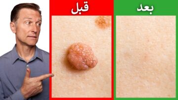 بدون ليزر.. أقوي علاج منزلي للتخلص من الزوائد الجلدية في الجسم والرقبة في المنزل بطريقة طبيعية