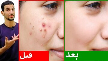 أفضل وصفات طبيعية لعلاج الحبوب من البشرة هتختفي من أول يوم