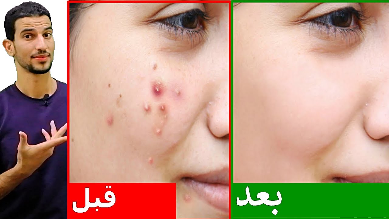 أفضل وصفات طبيعية لعلاج الحبوب من البشرة هتختفي من أول يوم 5 أفضل وصفات طبيعية لعلاج الحبوب من البشرة هتختفي من أول يوم
