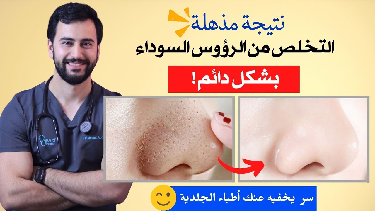 تخلصي في الحال من الرؤوس السوداء من الأنف بأقل التكاليف وأسهل الخطوات