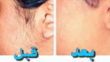 بدون ألم نهائي.. وصفة الفازلين والكركم السحرية لإزالة شغر الوجه والجسم كله من الجذور في ثواني وتبيض المناطق الحساسة