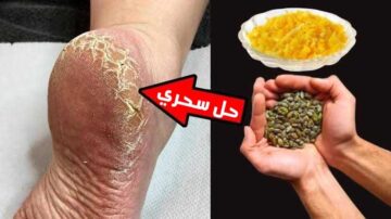 كعبك هينور زى الشمعه.. تبييض الكعبين وازالة التشققات والسواد بسهوله في منزلك بدون كوافير