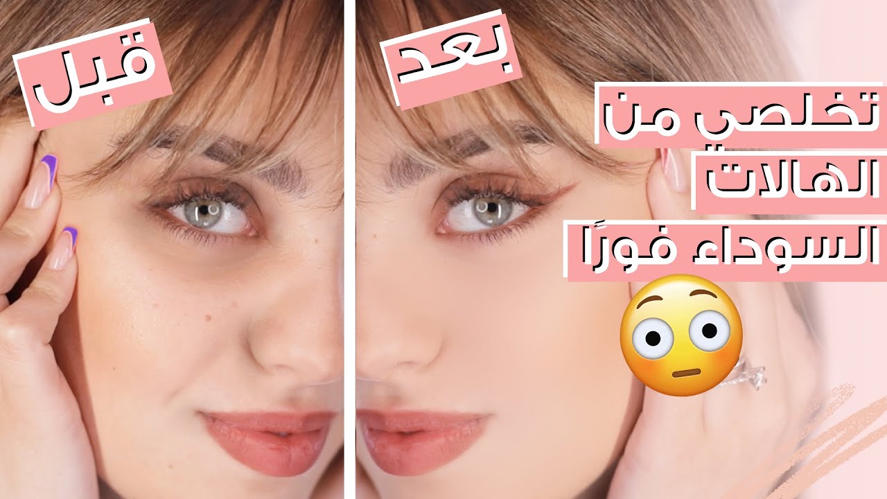 تخلصي من الهالات السوداء في أسبوع واحد باستخدام خلطات طبيعية 100%