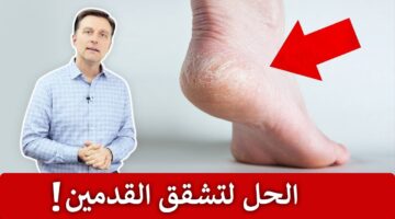 علاج تشقق القدمين