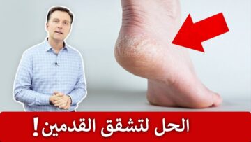 علاج تشقق القدمين بمكونات متوفرة في البيت ونتيجة سريعة ومضمونة