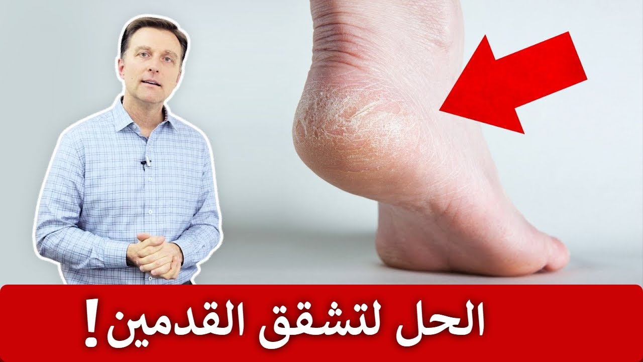علاج تشقق القدمين بمكونات متوفرة في البيت ونتيجة سريعة ومضمونة