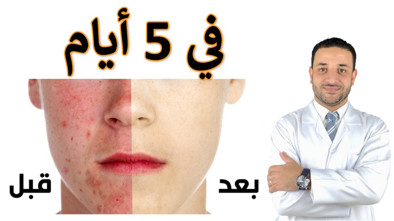 مكون رائع لحب الشباب في منزلك هيقضي على الحبوب وآثارها نهائيًا من أول مرة 5 مكون رائع لحب الشباب في منزلك هيقضي على الحبوب وآثارها نهائيًا من أول مرة