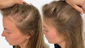 وصفات طبيعية لعلاج تساقط الشعر بشكل طبيعي!!