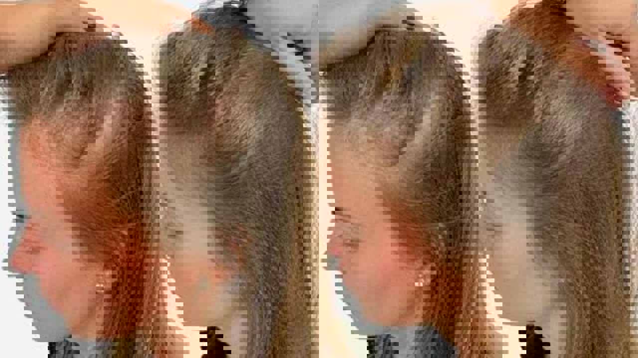 وصفات طبيعية لعلاج تساقط الشعر بشكل طبيعي!! 5 وصفات طبيعية لعلاج تساقط الشعر بشكل طبيعي!!