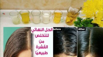 وصفات طبيعية لقشرة الشعر