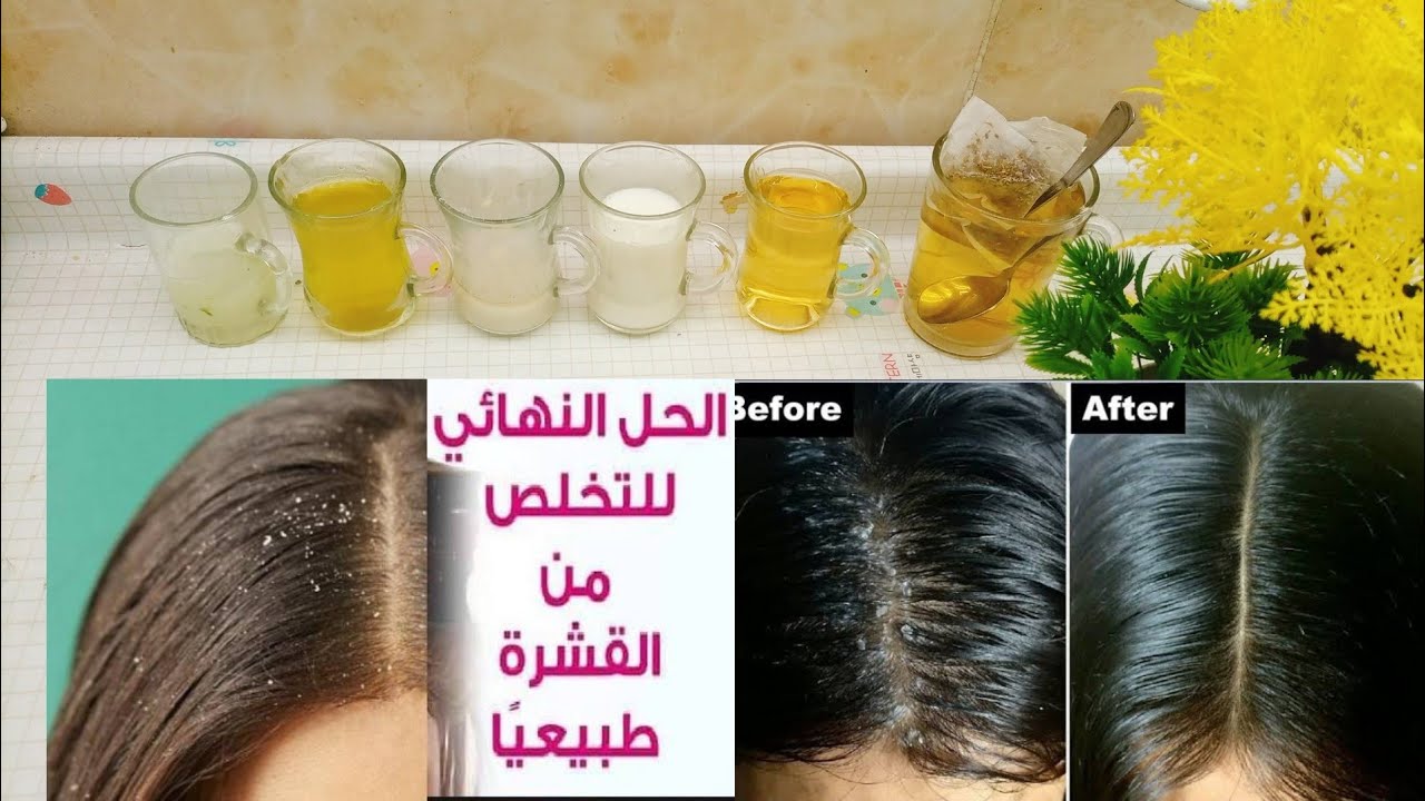 وصفات طبيعية لقشرة الشعر وكيفية التخلص منها بشكل طبيعي!!