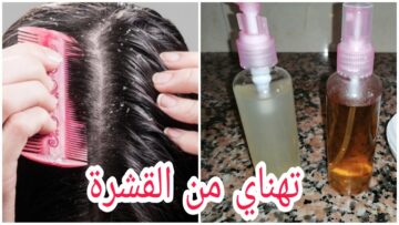 بدون أي أضرار.. وصفات طبيعية للقشرة وتساقط الشعر!!