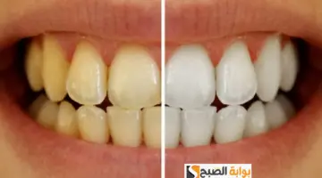 وصفه سحرية لتبييض الأسنان