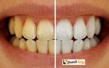 وصفة طبيعية من القرنفل لتبييض الأسنان والتخلص من اللون الأصفر.. هتشيل الجير المتراكم في دقائق