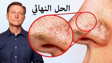 بمكونات صحية ومن منزلك تخلصي من الرؤوس السوداء نهائياً بوصفة طبيعية خالية من أي أضرار