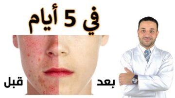 مضمونة وفعالة.. وصفة طبيعية لعلاج حب الشباب وآثاره نهائياً باستخدام مكونات في بيتك