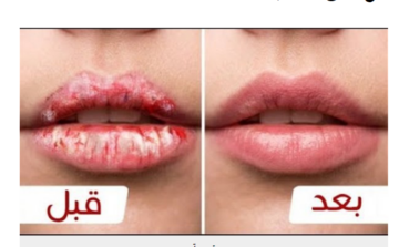 أفضل الوصفات الطبيعية للتخلص من تشقق وجفاف الشفايف