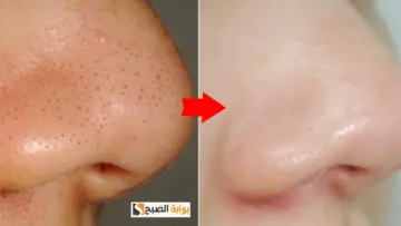 بشكل فعال من أول مرة.. طريقة مجربة للتخلص من الرؤوس السوداء والبثور تحت الجلد بمكونات طبيعية ونتائج وقتية