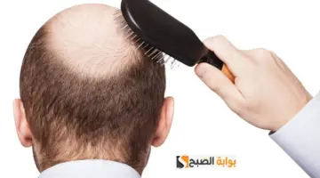 القضاء على تساقط الشعر