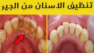 تنظيف الجير من الأسنان فى المنزل بطرق طبيعية في المنزل بدون الحاجة لزيارة الطبيب المكلفة