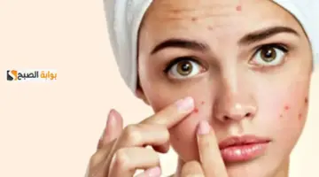 حبوب البشرة المختلطة