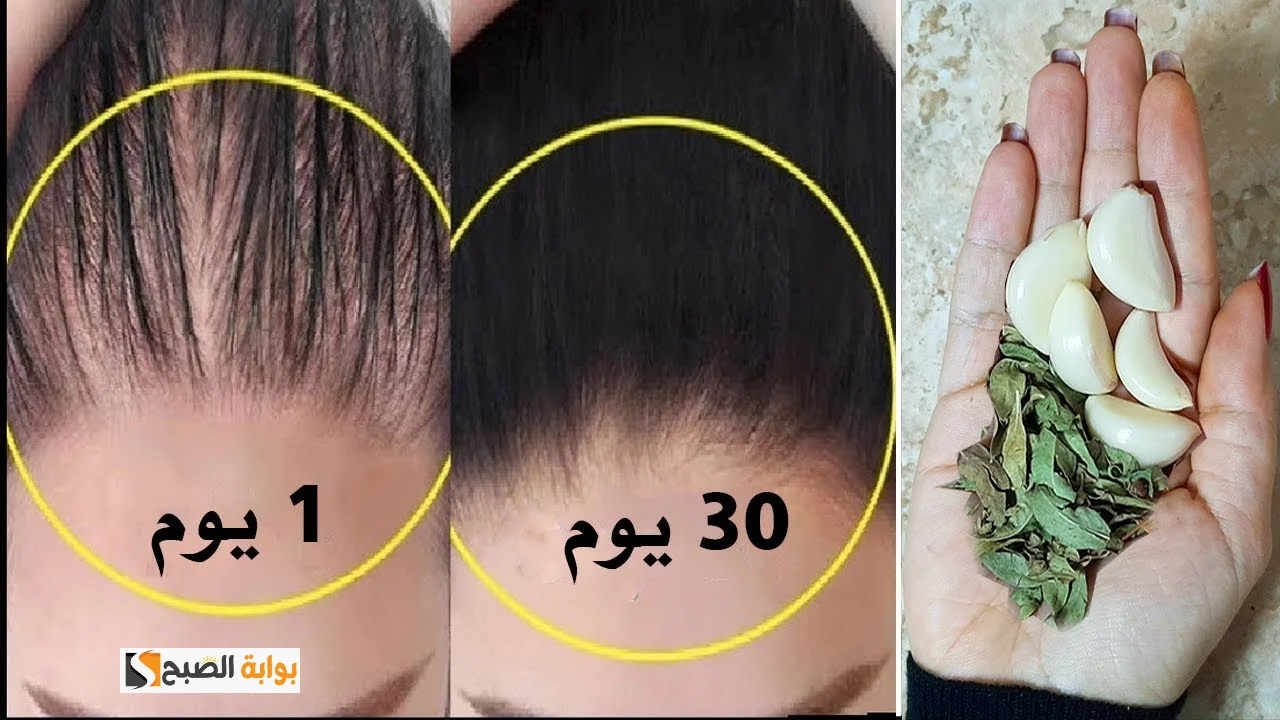 بطريقة طبيعية وأمنة.. وصفة منزلية لإنبات فراغات الشعر ومقدمة الرأس بسرعة الصاروخ 5 بطريقة طبيعية وأمنة.. وصفة منزلية لإنبات فراغات الشعر ومقدمة الرأس بسرعة الصاروخ