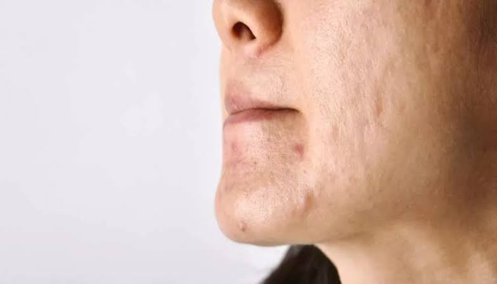 طرق علاج ندبات حب الشباب بالوصفات الطبيعية في المنزل 5 طرق علاج ندبات حب الشباب بالوصفات الطبيعية في المنزل