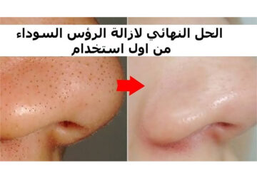 بشرة نضرة خالية من الرؤوس السوداء: حلول فعالة للتخلص منها في أقل وقت!